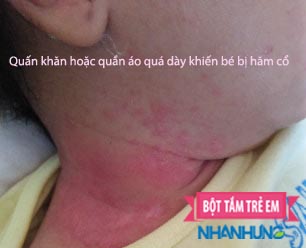 Quấn khăn quá dày cũng lam vùng cổ bé bị hăm