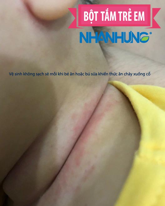 Vệ sinh không sạch sẽ vùng cổ sau mỗi bữa ăn hoặc cho trẻ bú sữa khiến bé bị hăm da vùng cổ