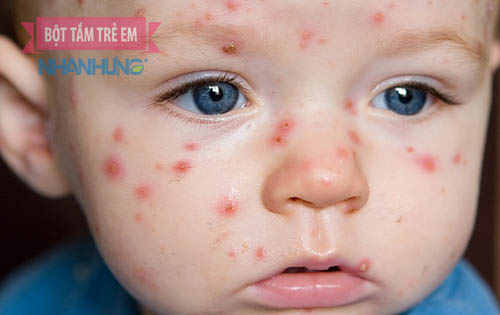 Trẻ bị mụn nhọt là do cơ thể tích tụ nhiều độc tố sinh ra nhiệt độc