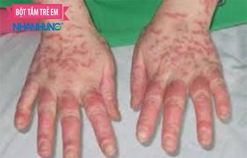 Bệnh lupus ban đỏ làm suy giảm hệ miễn dịch của trẻ