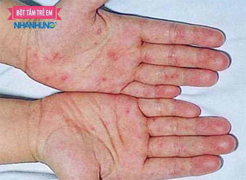 Chân tay miệng ảnh là một trong những bệnh thường gặp ở trẻ