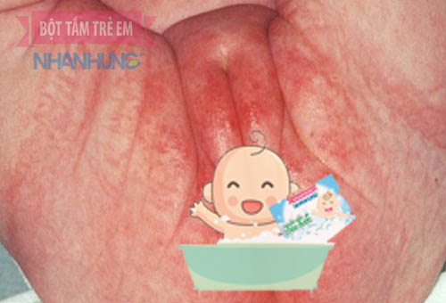 Trẻ bị nổi mẩn đỏ ở bộ phận sinh dục rất nguy hiểm cha mẹ chớ nên coi thường
