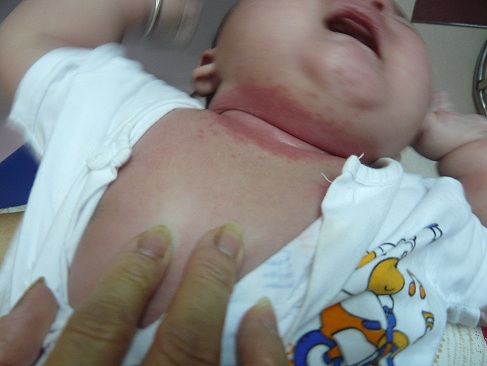 Hăm cổ khiến trẻ đau đớn, quấy khóc