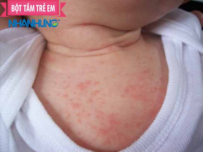 Cổ, lưng, ngực, da đầu là những khu vực rôm sảy cực yêu thích