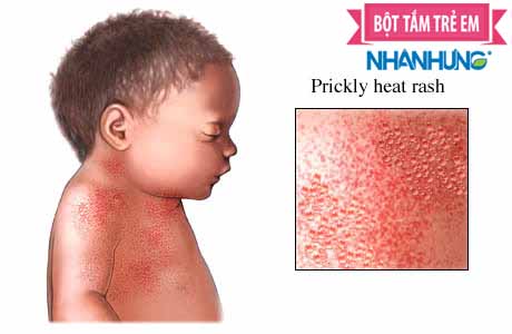 Rôm sảy thường khiến trẻ ngứa ngáy, khó chịu