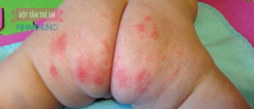 Đóng bỉm nhiều là căn nguyên gây hăm tã ở trẻ