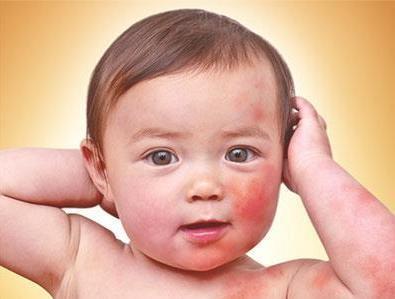 Chàm sữa ở bé sẽ nhanh chóng biến mất khi mẹ xử trí đúng cách