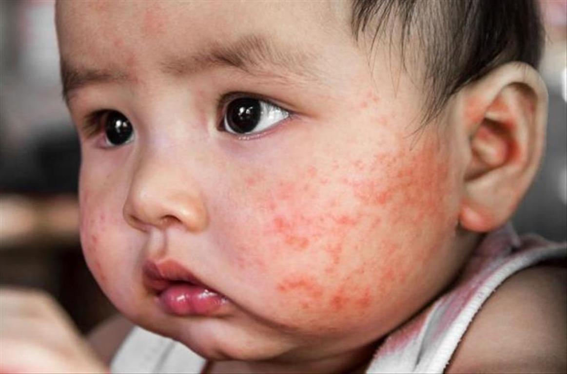 Chàm sữa rất dễ để lại sẹo nếu không được điều trị kịp thời