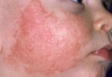 Biểu hiện ngoài da của bệnh chàm sữa - Chàm sữa là gì