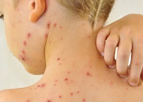 Cách xử trí hiệu quả nhất là tập cho trẻ có thói quen vệ sinh cá nhân sạch sẽ