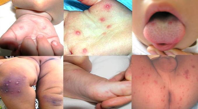 Rất nhiều trẻ trở thành “nạn nhân” của các bệnh ngoài da