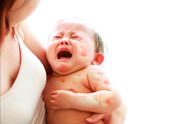 Nhiều trẻ phải nhập viện cấp cứu vì mắc bệnh ngoài da