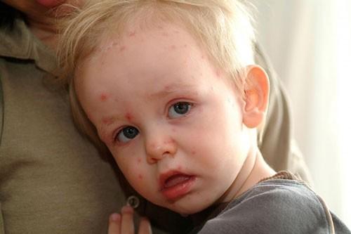 Mụn nhọt nếu không điều trị sẽ gây viêm thận cấp, nhiễm khuẩn huyết...