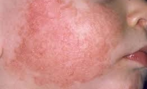 Biểu hiện chàm sữa ở trên mặt trẻ