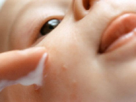 Mẹ có thể sử dụng kem bôi trị mụn nhọt cho trẻ