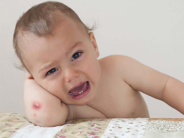 Thuốc chữa mụn nhọt - Mụn nhọt khiến trẻ đau đớn, khó chịu