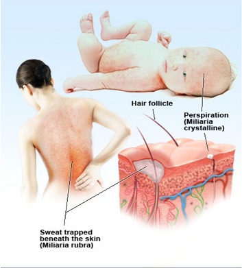 Những vị trí dễ mọc rôm sảy