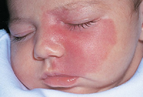 Giai đoạn đầu chàm làm tẩy đỏ khắp vùng mặt của bé