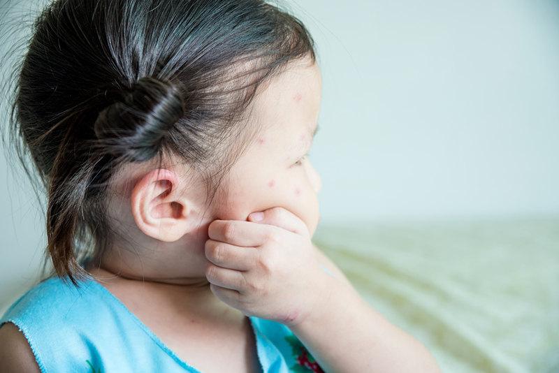 Hạn chế để trẻ đưa tay lên gãi quá nhiều