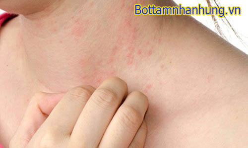 Rôm sảy xuất hiện nhiều khi thời tiết nắng nóng