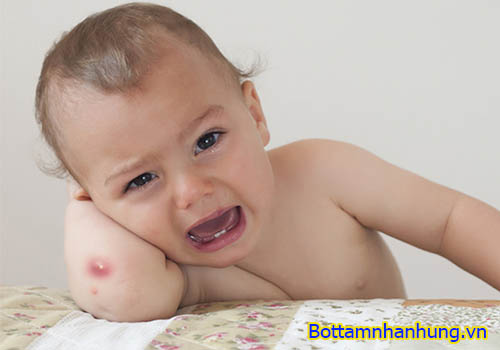 Mụn nhọt ở trẻ không thể coi thường