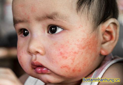 Chàm sữa xuất hiện khi bé 2 tháng tuổi kéo dài tới 2 tuổi