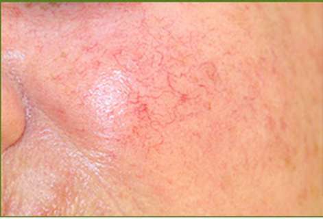 Teo da, nhiễm trùng da khi sử dụng sản phẩm chứa Corticoid