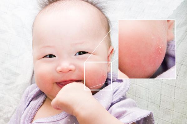 “Thủ phạm” gây chàm sữa do cơ địa dị ứng và các yếu tố dị ứng