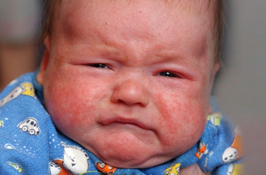 Có nhiều nguyên nhân gây ra bệnh eczema ở trẻ