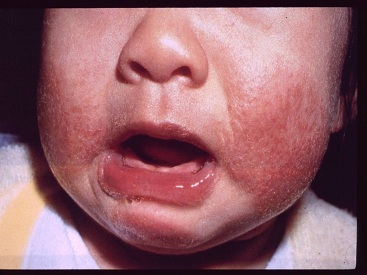 Bệnh eczema có thể khiến da mặt trẻ xù xì, thô ráp