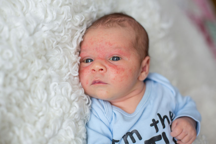 Bệnh eczema rất thường gặp ở trẻ nhỏ