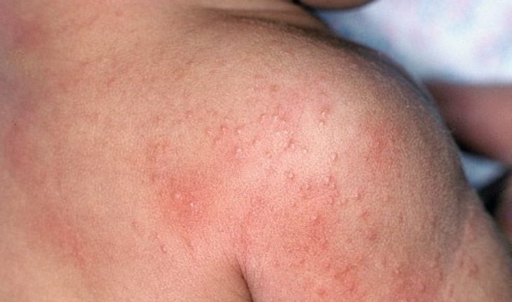 Mách mẹ cách trị rôm sảy ở trẻ nhỏ - Rôm sảy thường mọc tại các vị trí tiết nhiều mồ hôi, khu vực tiếp xúc với không khí ô nhiễm...
