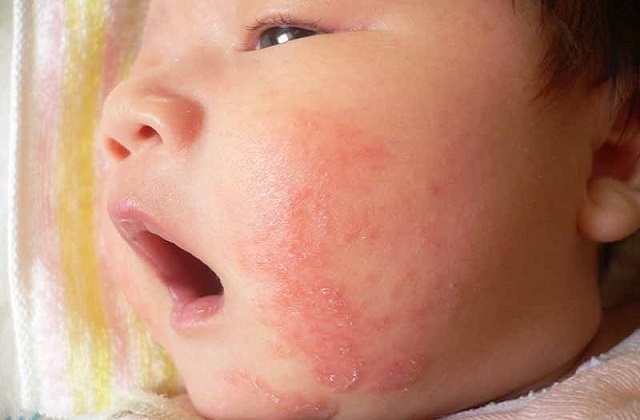 Giai đoạn 3: Da khô, bong tróc vảy