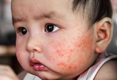 Giai đoạn 1: Ửng đỏ, căng da