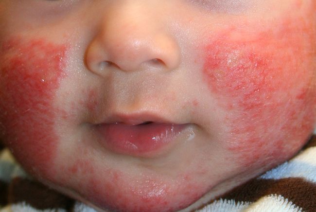 Chàm sữa khiến trẻ rất ngứa ngáy, khó chịu