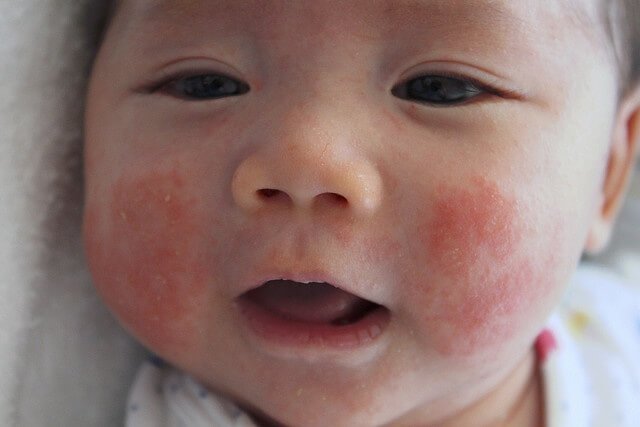 Chỉ cần thời tiết thay đổi là chàm sữa xuất hiện ngay