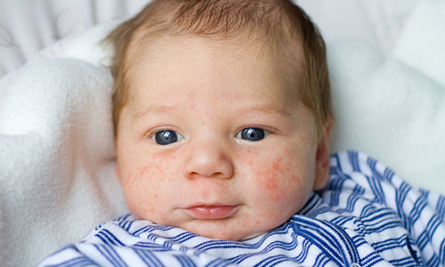 Chàm sữa rỉ nước là giai đoạn nguy hiểm dễ dẫn tới chàm bội nhiễm và nhiễm trùng máu