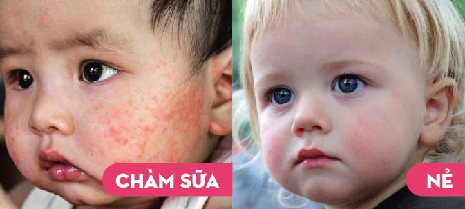 Chàm sữa và nẻ rất dễ bị nhầm lẫn