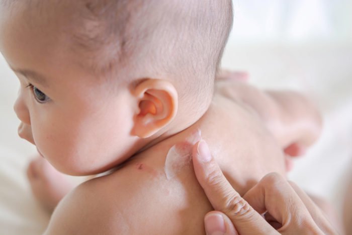 Lợi bất cập hại khi sử dụng kem bôi có chứa corticoid