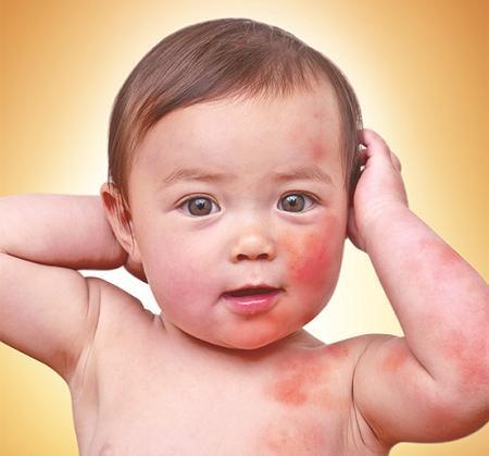 Bệnh ngoài da ở trẻ sẽ nghiêm trọng nếu mẹ mắc sai lầm khi điều trị