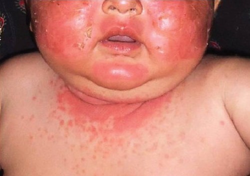 Đừng để trả giá đắt vì sự chủ quan với chàm sữa