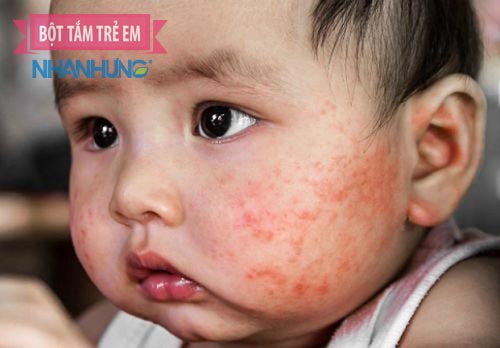 Da bé nổi hồng ban, khô ráp, da viêm, gây ngứa… là những dấu hiệu tố cáo trẻ bị chàm sữa