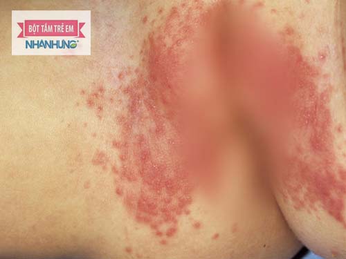 Bé bị đỏ quanh hậu môn là dấu hiệu của bệnh hăm tã
