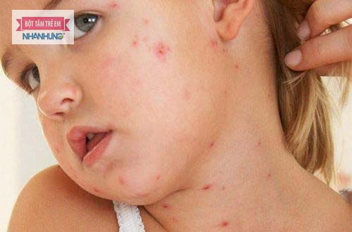 Trẻ có thể bị mẩn ngứa ở từng khu vực hoặc khắp cơ thể