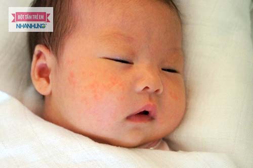 Rất nhiều trẻ bị mẩn ngứa như muỗi đốt