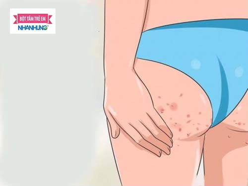 Bé bị mụn nhọt ở mông do nhiều nguyên nhân gây nên