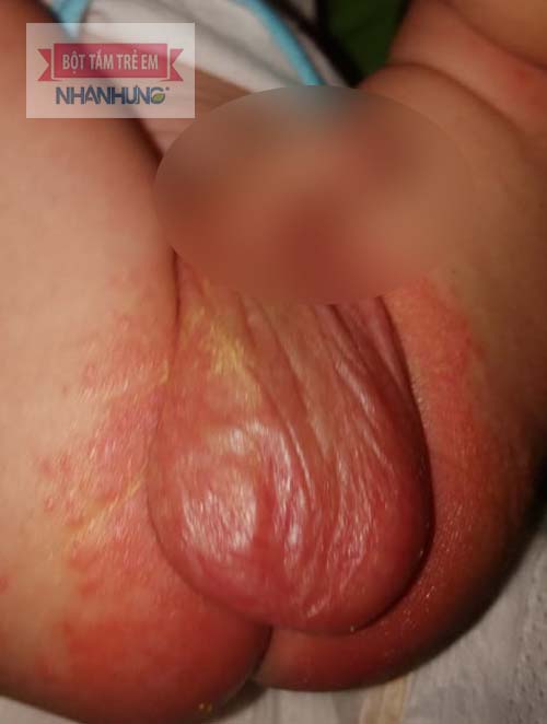 Bé bị mẩn đỏ ở háng do vệ sinh không sạch sẽ