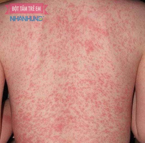 Trẻ bị rôm sảy gây mẩn ngứa, nổi mụn khắp người