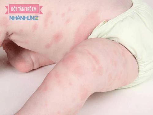 Dị ứng nổi mề đay có thể xuất hiện ở nhiều vùng da khác ngoài mông