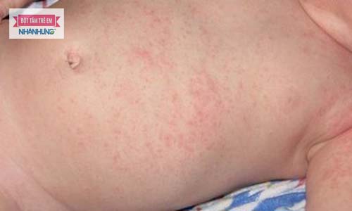 Rôm sảy có thể mọc ở bất cứ vị trí nào trên cơ thể trẻ - Bé bị rôm sảy bôi thuốc gì